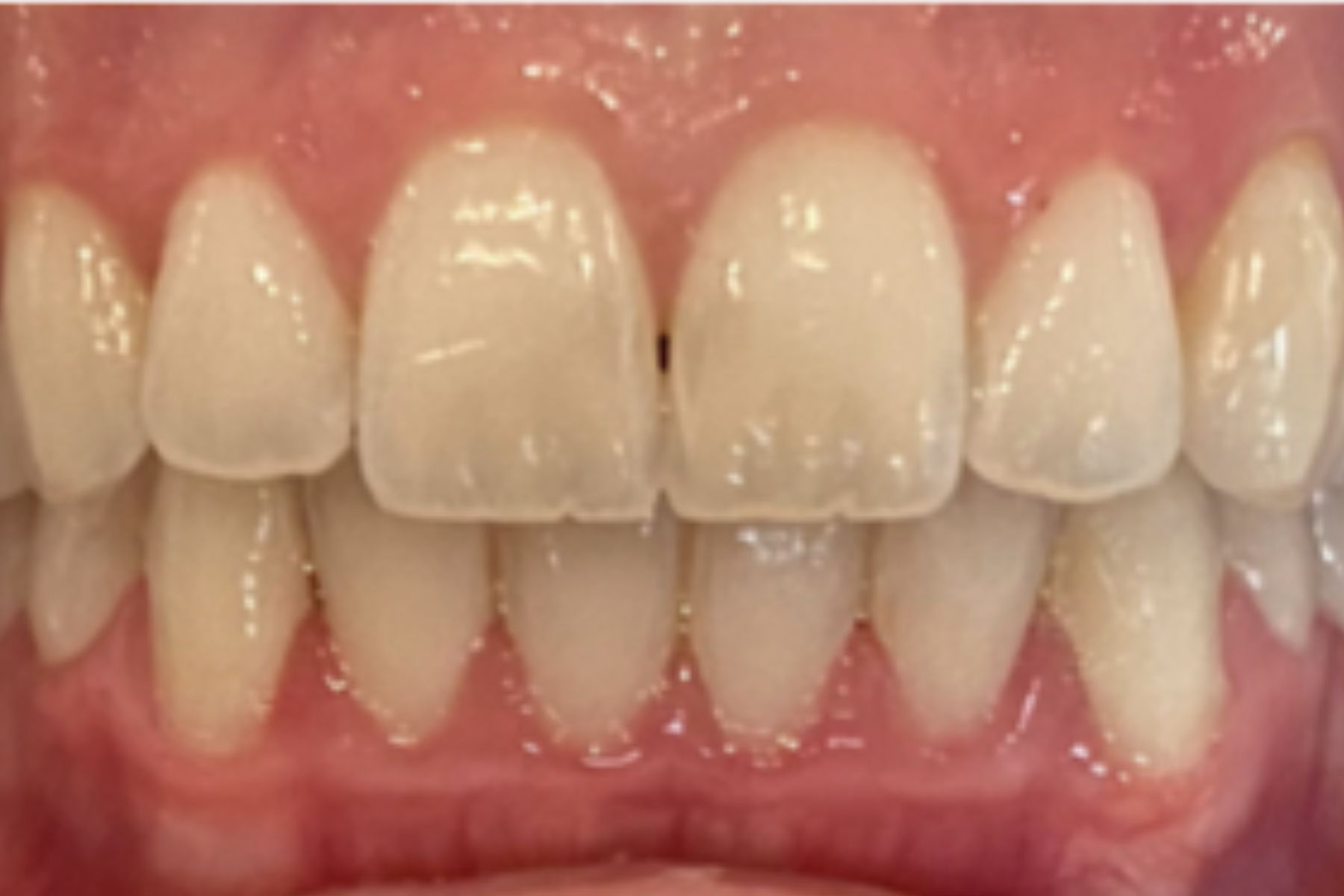 قبل از سفید کردن